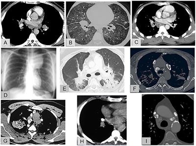 Differential diagnosis of pulmonary sarcoidosis: a review